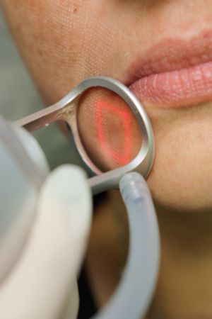 Fractional Laser