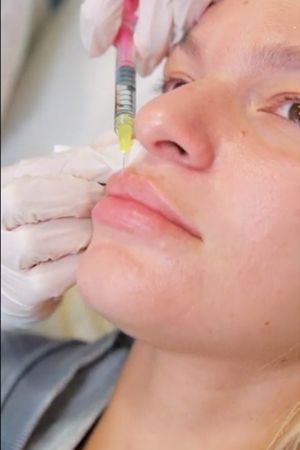 Fillers