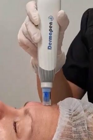 Dermapen