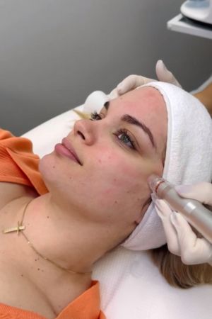 Hydradermabrassion