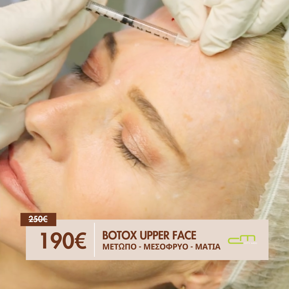 Botox Upper Face 190€